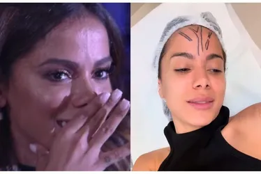 Imagem ilustrativa da imagem Anitta faz cirurgia para remover veia saltada na testa
