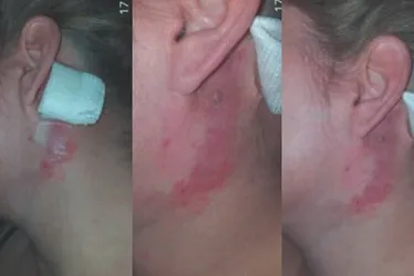 Imagem ilustrativa da imagem Clínica de estética: paciente não consegue fechar o olho após procedimento