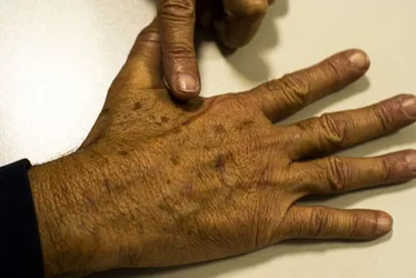 Imagem ilustrativa da imagem Dezembro Laranja: pessoas de pele negra podem desenvolver câncer