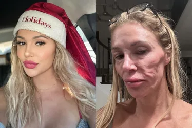 Imagem ilustrativa da imagem Ex-modelo mostra rosto 'derretido': 'Médicos dizem que tem um parasita'