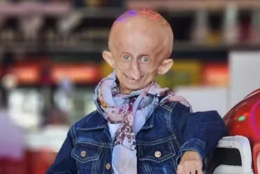 Imagem ilustrativa da imagem Morre Beandri Booysen, influenciadora do TikTok com doença rara, aos 19 anos