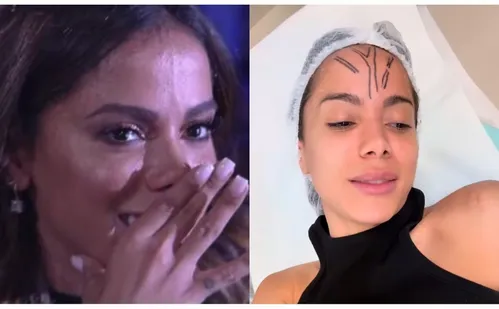 
          Imagem ilustrativa da imagem Anitta faz cirurgia para remover veia saltada na testa
          