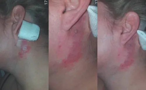 
          Imagem ilustrativa da imagem Clínica de estética: paciente não consegue fechar o olho após procedimento
          