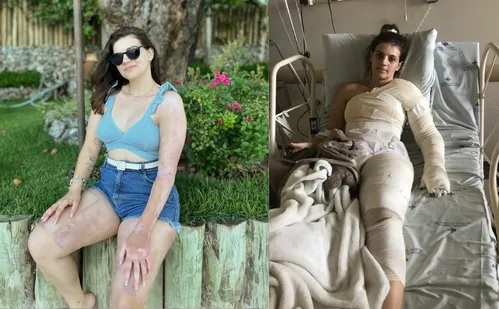 
          Imagem ilustrativa da imagem Nada de receita caseira: especialistas orientam cuidados com as queimaduras
          