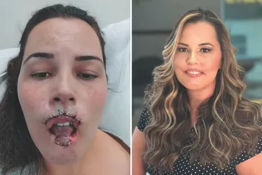 Imagem ilustrativa da imagem Anvisa vai decidir se proíbe de vez uso de "gel da beleza"