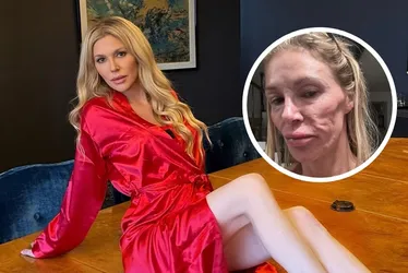 Imagem ilustrativa da imagem Com 'rosto derretido', Brandi Glanville passará por cirurgia; entenda