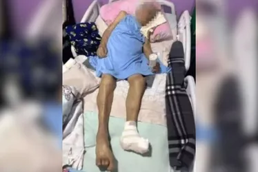 Imagem ilustrativa da imagem Idosa de 103 anos tem o pé amputado em casa e sem anestesia