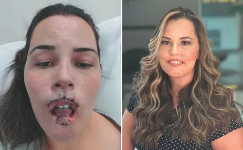 
          Imagem ilustrativa da imagem Anvisa vai decidir se proíbe de vez uso de "gel da beleza"
          