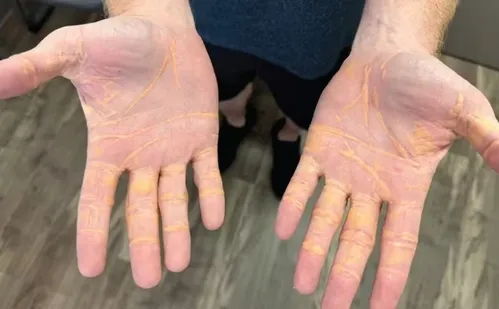 
          Imagem ilustrativa da imagem Homem acumula gordura e colesterol nas mãos após adotar dieta carnívora
          