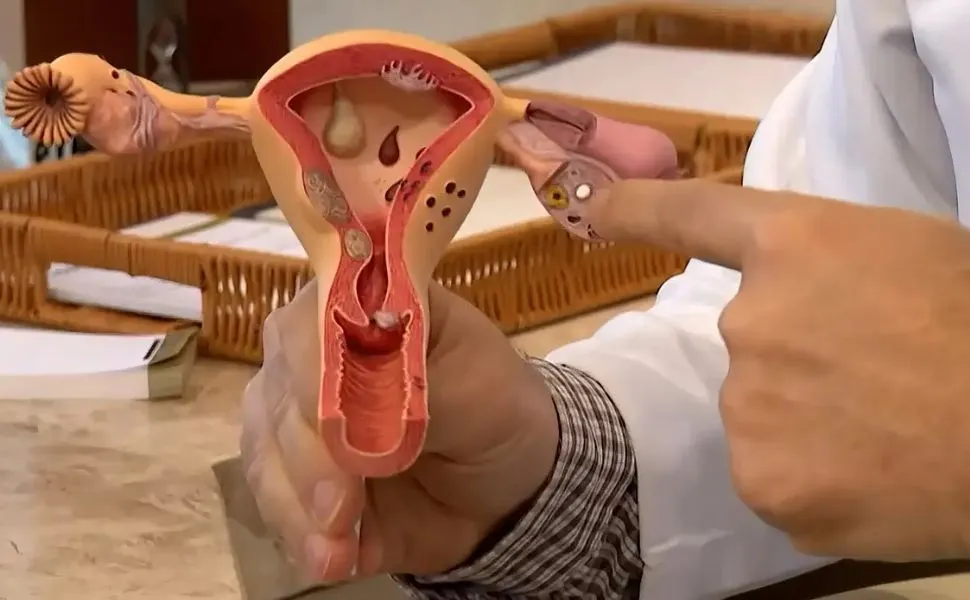 Imagem ilustrativa da imagem Endometriose: conheça os sintomas e saiba como tratar a doença
