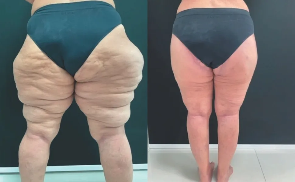 Imagem ilustrativa da imagem Lipedema: entenda doença que afeta 211 mil mulheres no ES