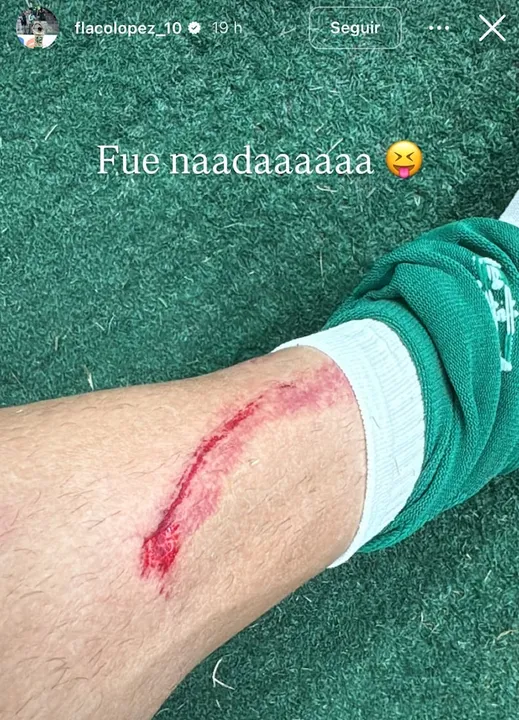 Imagem ilustrativa da imagem Flaco López posta foto de machucado e Palmeiras vai cobrar FPF por falta de revisão do VAR