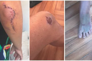 Imagem ilustrativa da imagem Aposentada teve que pagar R$ 13 mil em cirurgia após ser atropelada por patinete