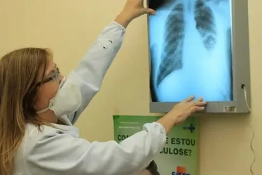 Imagem ilustrativa da imagem Baixo financiamento mundial ameaça combate à tuberculose