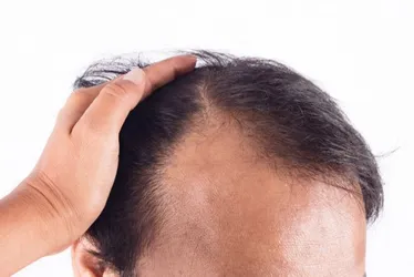 Imagem ilustrativa da imagem Cabelo é a preocupação da maioria dos homens