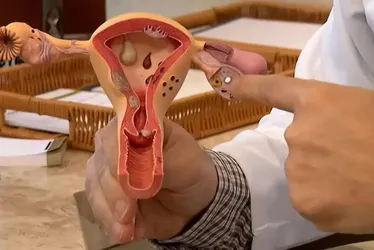 Imagem ilustrativa da imagem Endometriose: conheça os sintomas e saiba como tratar a doença