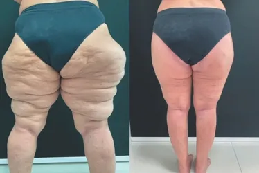 Imagem ilustrativa da imagem Lipedema: entenda doença que afeta 211 mil mulheres no ES