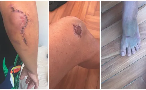 
          Imagem ilustrativa da imagem Aposentada teve que pagar R$ 13 mil em cirurgia após ser atropelada por patinete
          