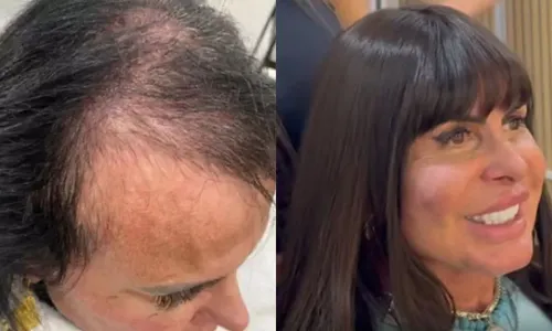 
          Imagem ilustrativa da imagem Gretchen revela calvície e adota novo visual para o Power Couple Brasil 2025
          