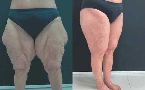 
          Imagem ilustrativa da imagem Lipedema: entenda doença que afeta 211 mil mulheres no ES
          