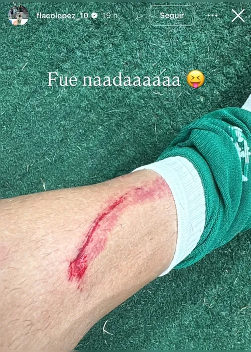 Imagem ilustrativa da imagem Flaco López posta foto de machucado e Palmeiras vai cobrar FPF por falta de revisão do VAR