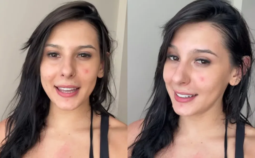 Imagem ilustrativa da imagem Ana Castela abre o jogo sobre acne e diz que mudou de vida: 'me sentindo feliz'