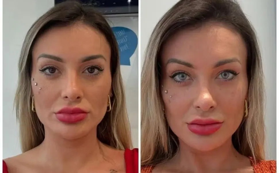 Imagem ilustrativa da imagem Riscos no procedimento para mudar a cor dos olhos, como fez Andressa Urach