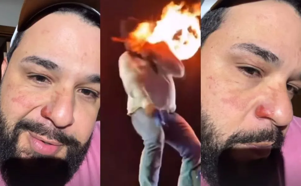 Imagem ilustrativa da imagem Sertanejo Léo mostra cicatrizes após ter rosto atingido por chamas durante show