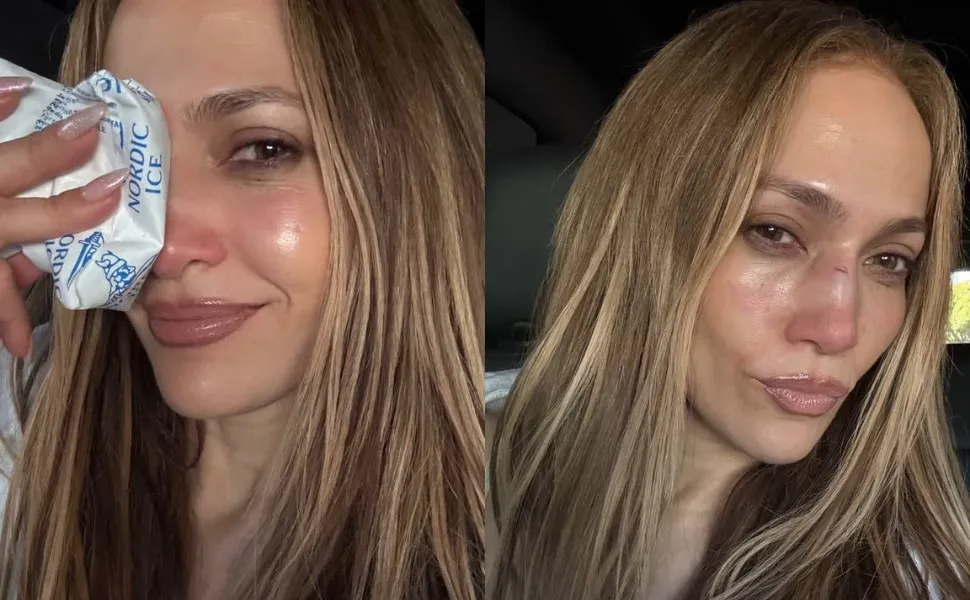 Imagem ilustrativa da imagem Jennifer Lopez sofre acidente em ensaio de premiação e leva pontos no rosto