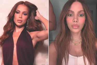 Imagem ilustrativa da imagem Médicos explicam mudanças e o novo visual de Anitta