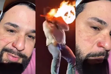 Imagem ilustrativa da imagem Sertanejo Léo mostra cicatrizes após ter rosto atingido por chamas durante show