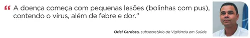 
          Imagem ilustrativa da imagem Cinco casos de Mpox são confirmados no ES e outros 14 estão em investigação
          