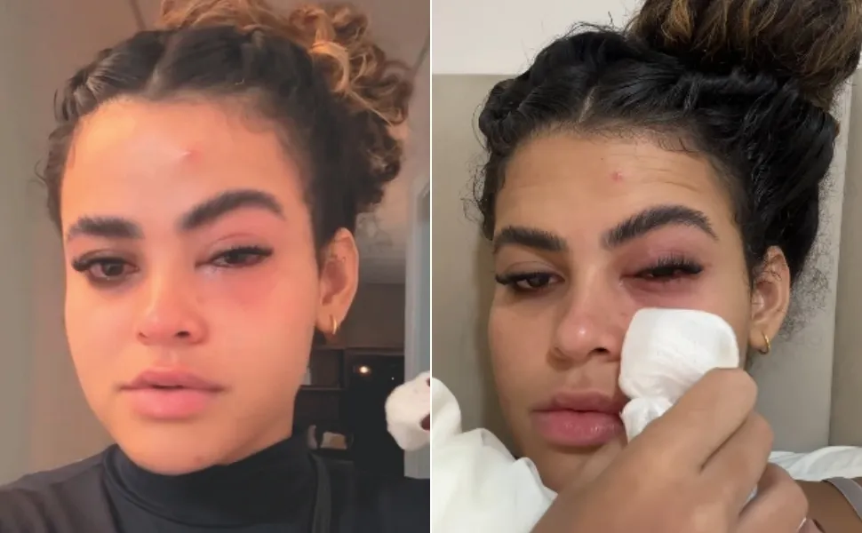Imagem ilustrativa da imagem Médicos explicam inflamação no olho causada por mosca de banheiro