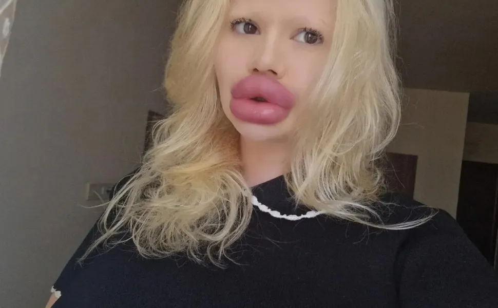 Imagem ilustrativa da imagem Mulher com maiores lábios do mundo diz que dentistas não querem atendê-la