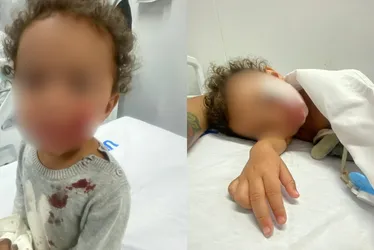 Imagem ilustrativa da imagem Bebê de 1 ano é atacado no rosto por pitbull no Sul do ES