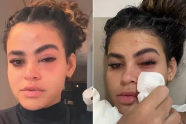 Imagem ilustrativa da imagem Médicos explicam inflamação no olho causada por mosca de banheiro