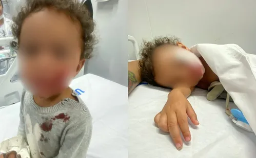 
          Imagem ilustrativa da imagem Bebê de 1 ano é atacado no rosto por pitbull no Sul do ES
          