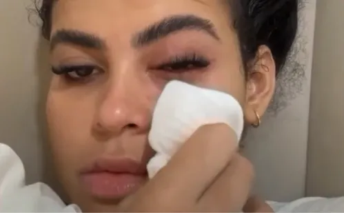 
          Imagem ilustrativa da imagem Influenciadora contrai infecção causada por mosca de banheiro na Serra
          