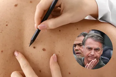 Imagem ilustrativa da imagem Câncer de pele de Bolsonaro é agressivo? Conheça características da doença