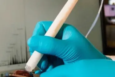 Imagem ilustrativa da imagem Caneta que detecta câncer durante cirurgia chega ao País