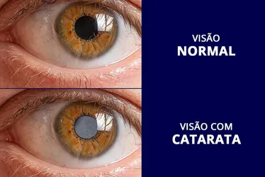 Imagem ilustrativa da imagem Cirurgia única corrige problemas de visão de longe e de perto