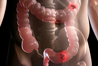 Imagem ilustrativa da imagem Estudo projeta aumento de 36% em mortes por câncer colorretal até 2040