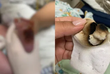 Imagem ilustrativa da imagem Funcionários são afastados após bebê ter pé queimado em hospital na Serra