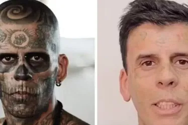 Imagem ilustrativa da imagem Homem mais tatuado do Brasil está irreconhecível após remoção de tatuagens