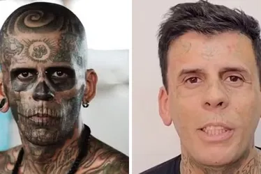 Imagem ilustrativa da imagem Mais tatuado do Brasil aparece irreconhecível após remoção de tatuagens