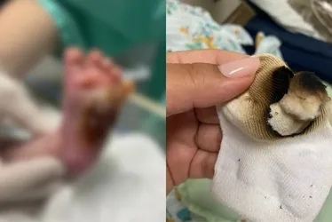 Imagem ilustrativa da imagem Técnica de enfermagem é demitida após bebê ter pé queimado em hospital da Serra