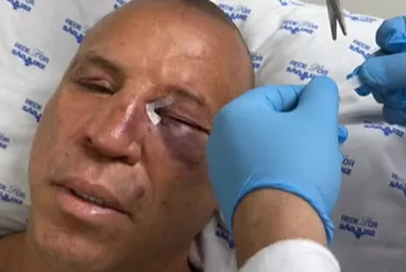 Imagem ilustrativa da imagem Wanderlei Silva teve nariz quebrado e recebeu pontos em briga após luta contra Popó