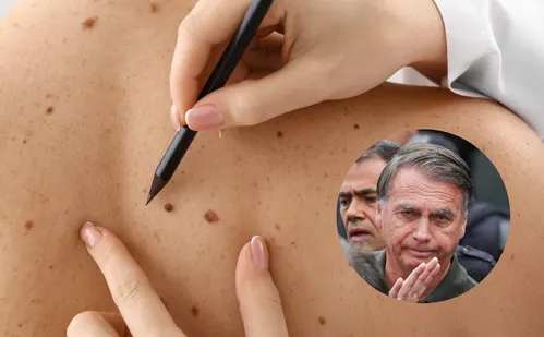 
          Imagem ilustrativa da imagem Câncer de pele de Bolsonaro é agressivo? Conheça características da doença
          