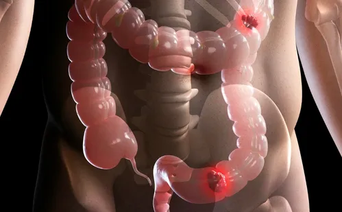 
          Imagem ilustrativa da imagem Estudo projeta aumento de 36% em mortes por câncer colorretal até 2040
          