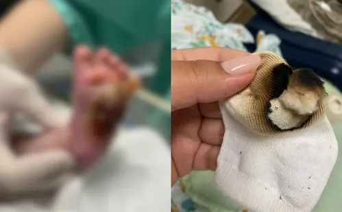 
          Imagem ilustrativa da imagem Técnica de enfermagem é demitida após bebê ter pé queimado em hospital da Serra
          